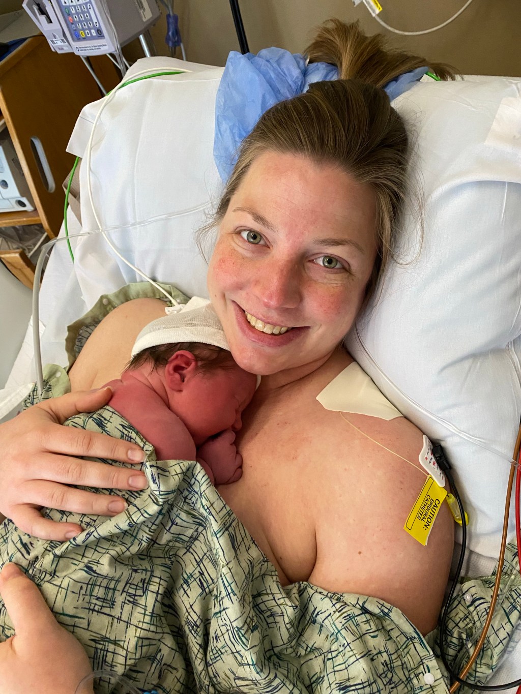 C-Section Delivery and Hospital Stay with Type 1&nbsp;Diabetes